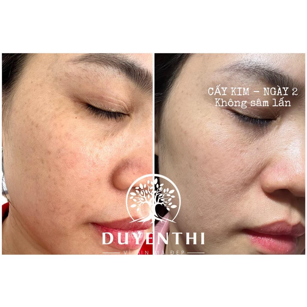Bạch Linh 12 Cấy Kim Duyên Thị Nanotech