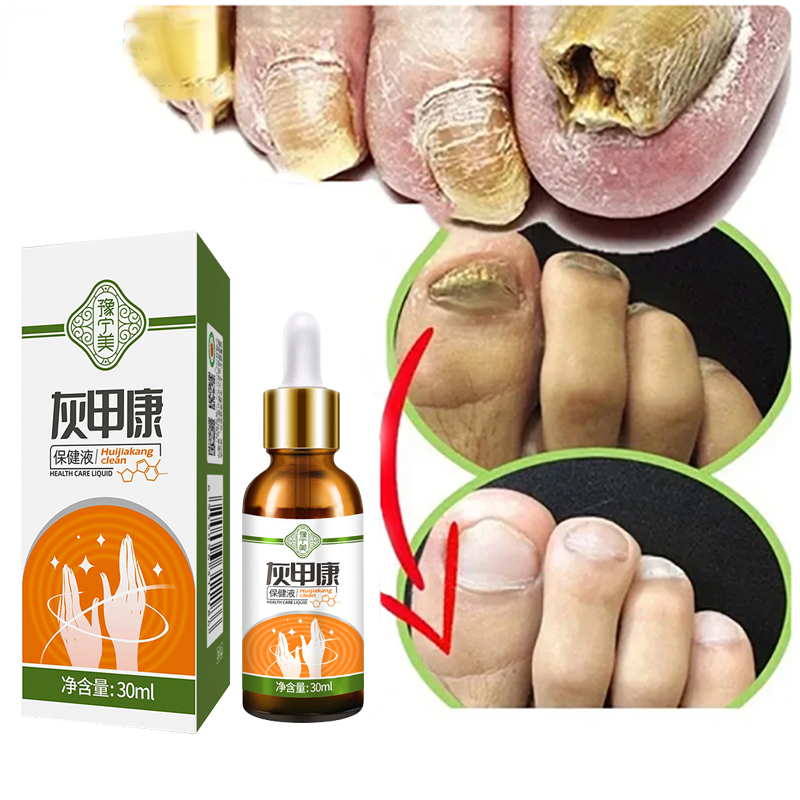 Kem nấm móng chân móng tay Nấm móng tay bị nứt 20g Nhanh chuẩn hiệu quả Phục hồi sâu Giúp bạn loại bỏ nấm móng