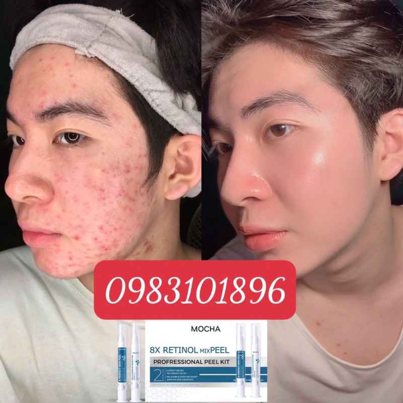 PEEL MOCHA MUA 1 ĐƯỢC 5 KÈM QUÀ TẶNG