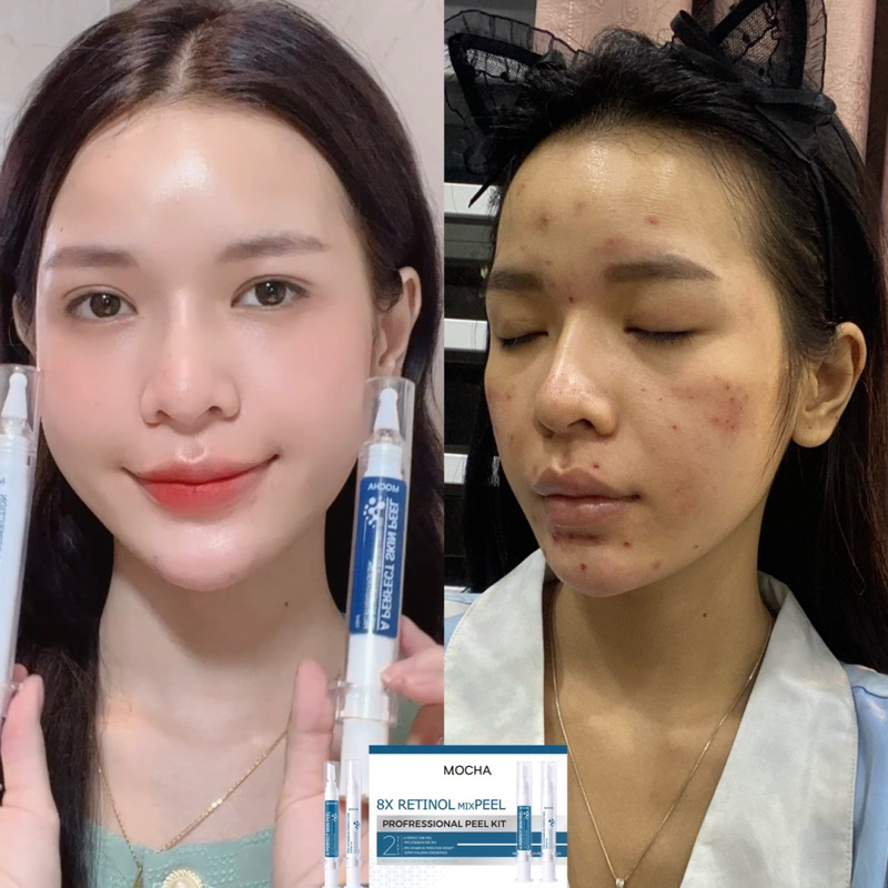 PEEL MOCHA MUA 1 ĐƯỢC 5 KÈM QUÀ TẶNG