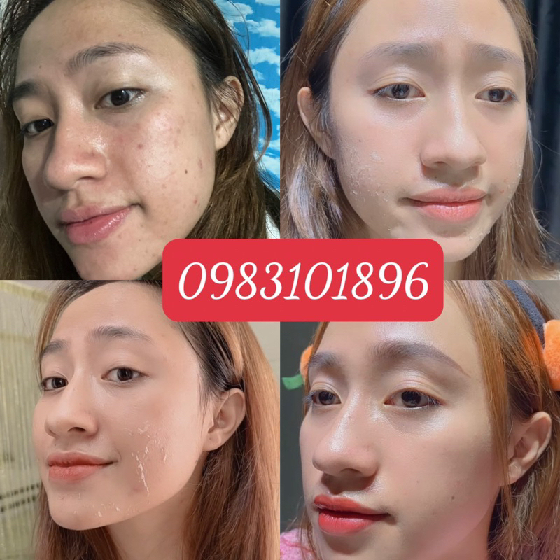 PEEL MOCHA MUA 1 ĐƯỢC 5 KÈM QUÀ TẶNG