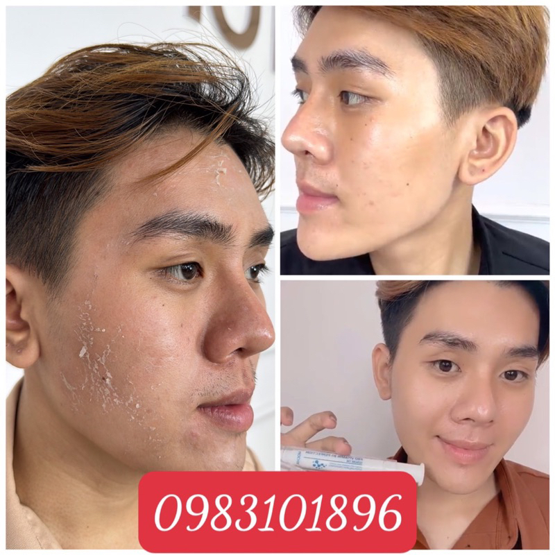 PEEL MOCHA MUA 1 ĐƯỢC 5 KÈM QUÀ TẶNG