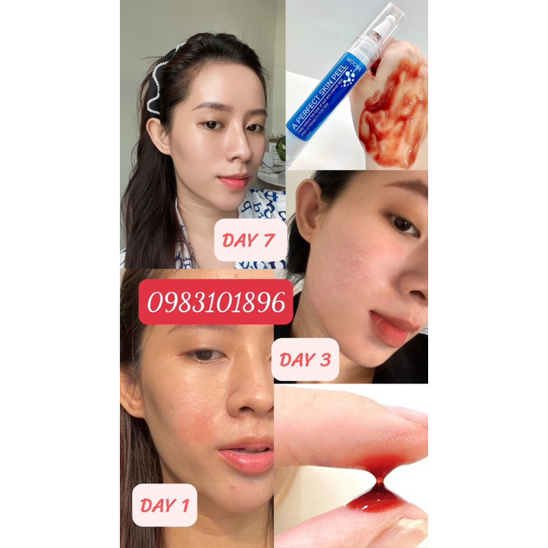 PEEL MOCHA MUA 1 ĐƯỢC 5 KÈM QUÀ TẶNG