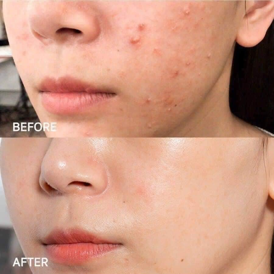 Kem Dưỡng ẨM Cho Da Dầu Mụn SVR SEBIACLEAR ACTIVE GEL ( Mẫu Mới) 40ml