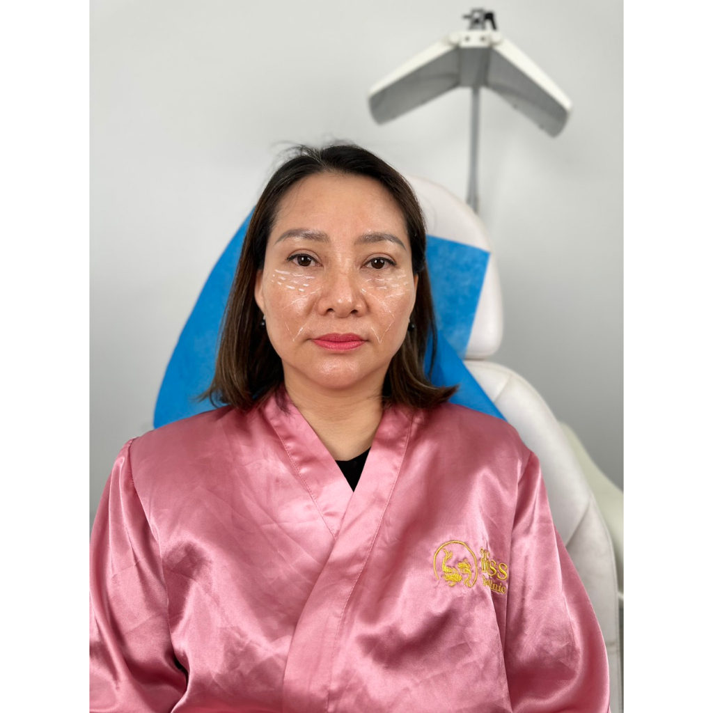 Bút Viscot đánh dấu filler, botox, căng chỉ, BAP
