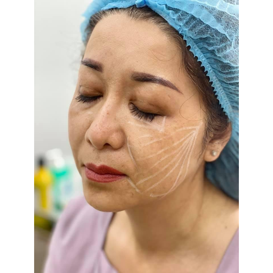 Bút Viscot đánh dấu filler, botox, căng chỉ, BAP