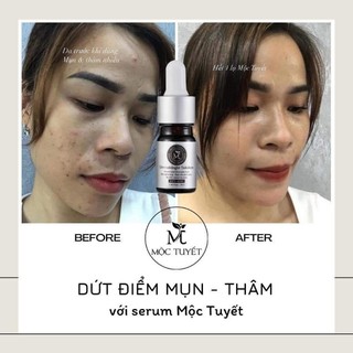 (DATE MỚI- QUÀ) COMBO 2 SERUM MỘC  TUYẾT MẪU MỚI