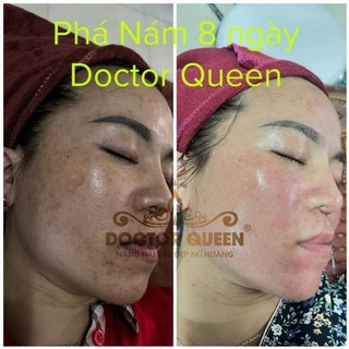 tinh chất ức chế nám số 2 DOCTOR QUEEN