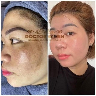 tinh chất ức chế nám số 2 DOCTOR QUEEN