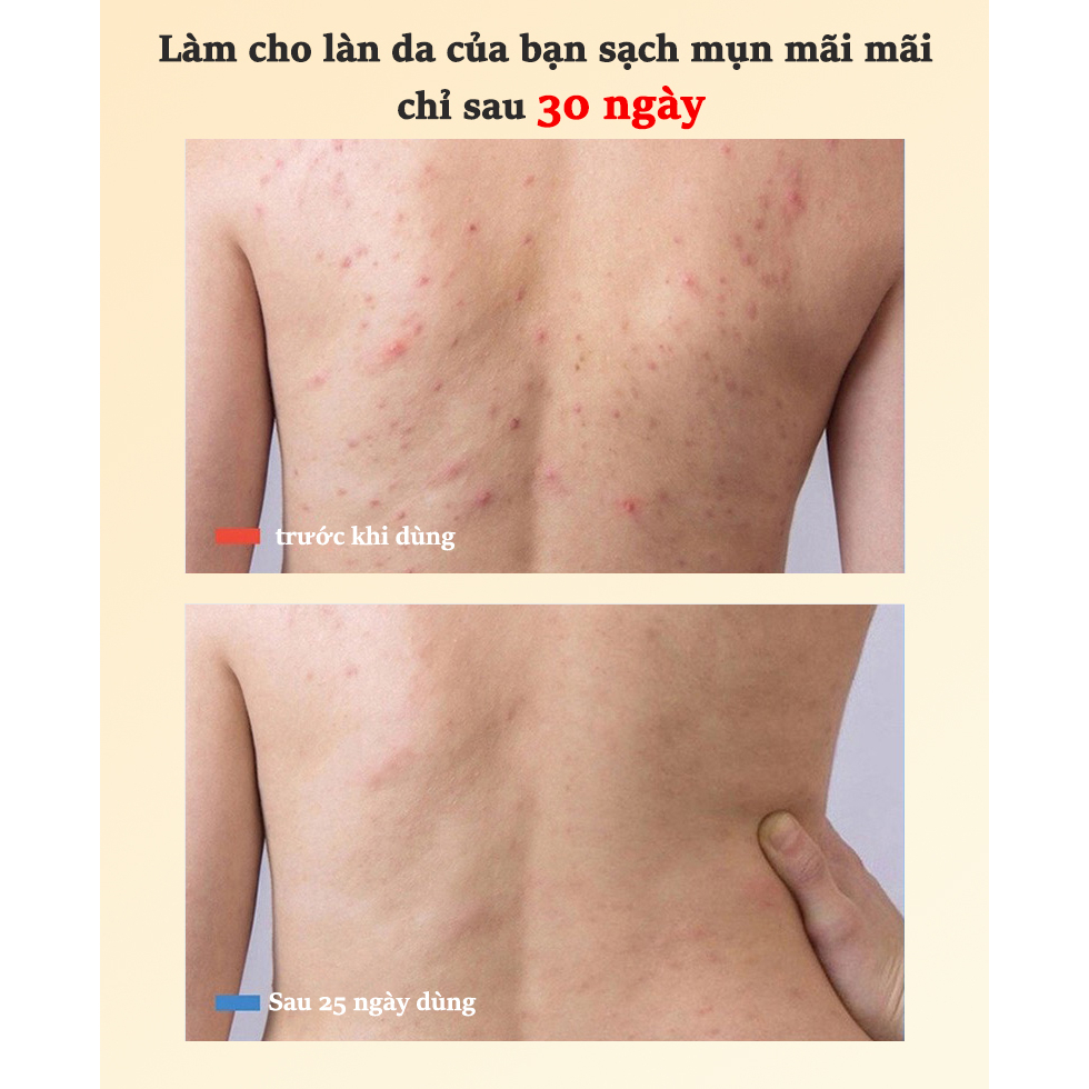 Sữa  tắm trắng da sữa tắm mụn lưng sữa tắm viêm nang lông 400ML chiết xuất 100% suối lưu huỳnh tự nhiên.