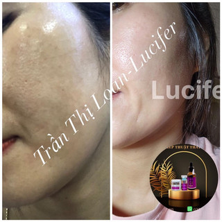 Tế Bào Gốc phục hồi EGF Lucifer