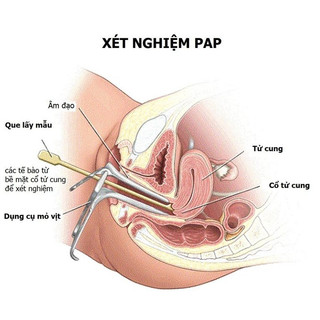 MỎ VỊT KHÁM SẢN PHỤ KHOA, mỏ vịt phụ khoa