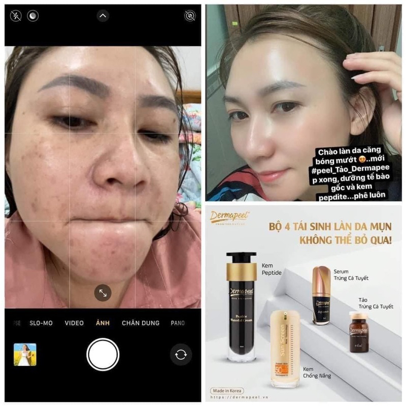 Combo xóa mụn tảo và serum trứng cá tuyết
