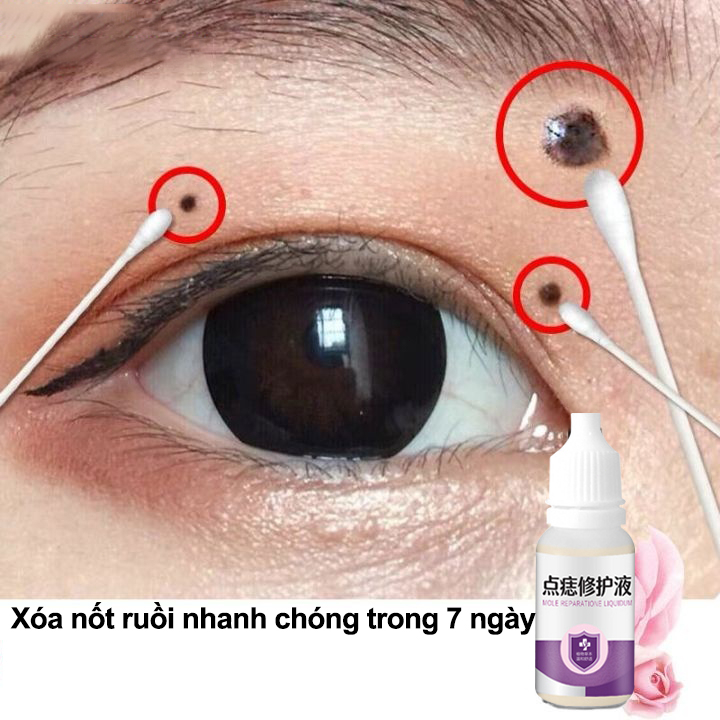 Dung dịch tẩy mụn ruồi Kem tẩy nốt ruồi Tẩy nốt ruồi nhanh chóng loại bỏ Mụn cơm Mụn ruồi đen Mụn ruồi lồi 10ml