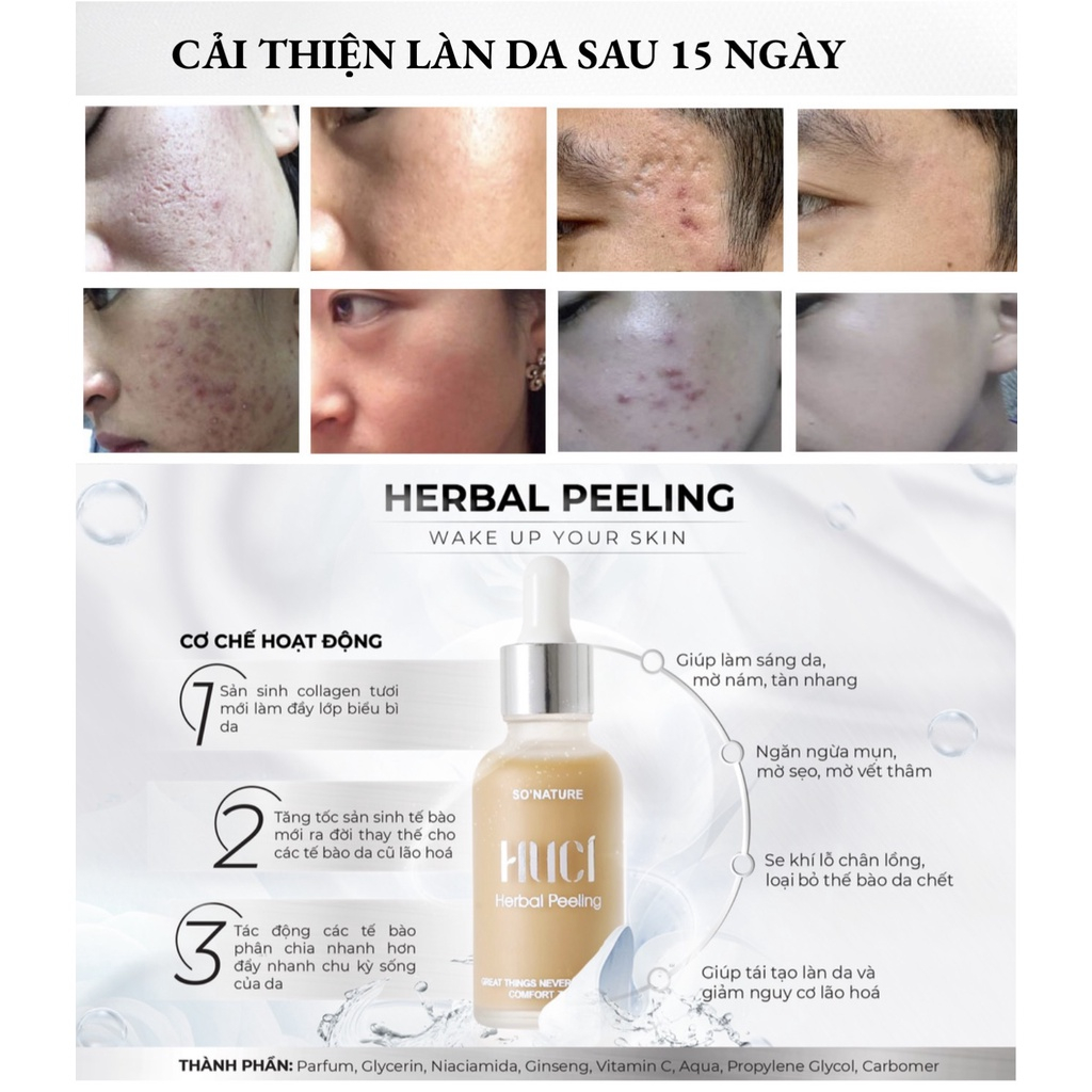 Tinh Chất HUCI Herbel Peeling Xóa Sẹo Rỗ Nâu Năm, Mụn Thâm, Chân Nám Tàn Nhang, Se Khít Lỗ Chân Lông 30ml