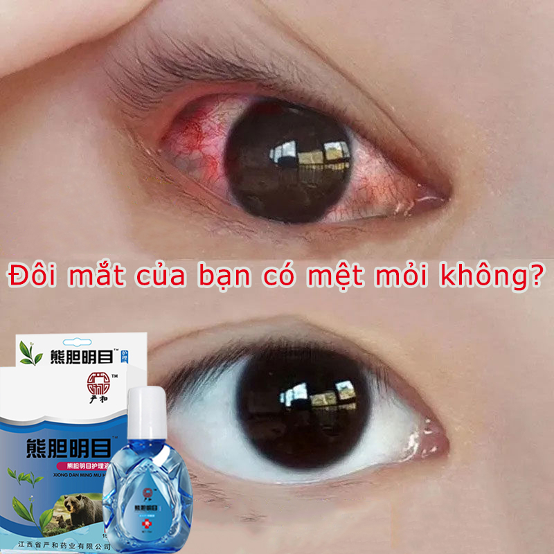 Nước nhỏ mắt cận thị Nước mắt nhân tạo 15ml Giúp cải thiện thị lực Loại bỏ mắt đỏ Giảm khô mắt Giảm mỏi mắt