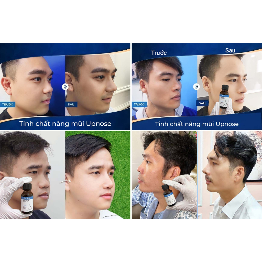 Tinh chất nâng mũi UPNOSE giúp định hình mũi chống nếp nhăn và chống lão hóa cao cấp 15ml