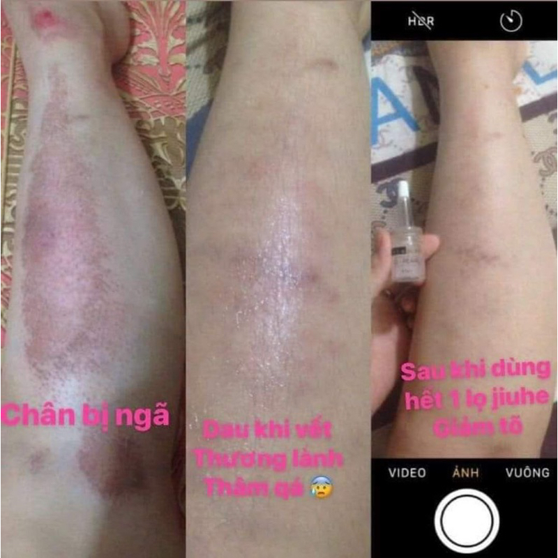 XẢ KHO combo 2 lọ mờ thâm jiuhe  , Jiuhechuẩn thanh tô  Á