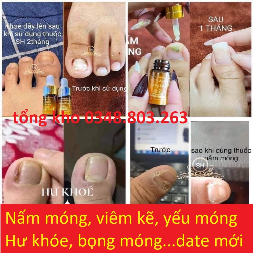 Serum SH đánh bay nấm móng, hư khoé, bọng móng, nước ăn tay chân viem móng