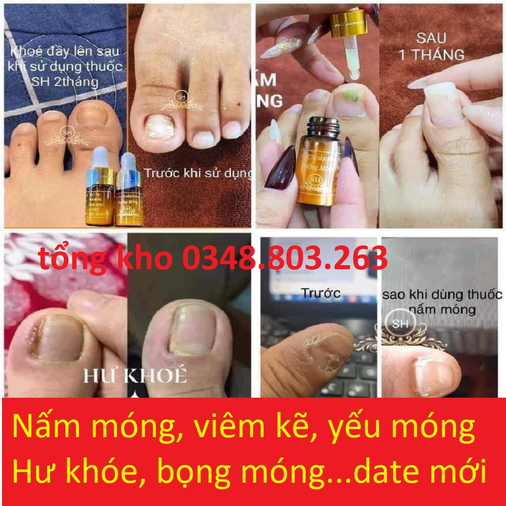 Serum SH đánh bay nấm móng, hư khoé, bọng móng, nước ăn tay chân viem móng