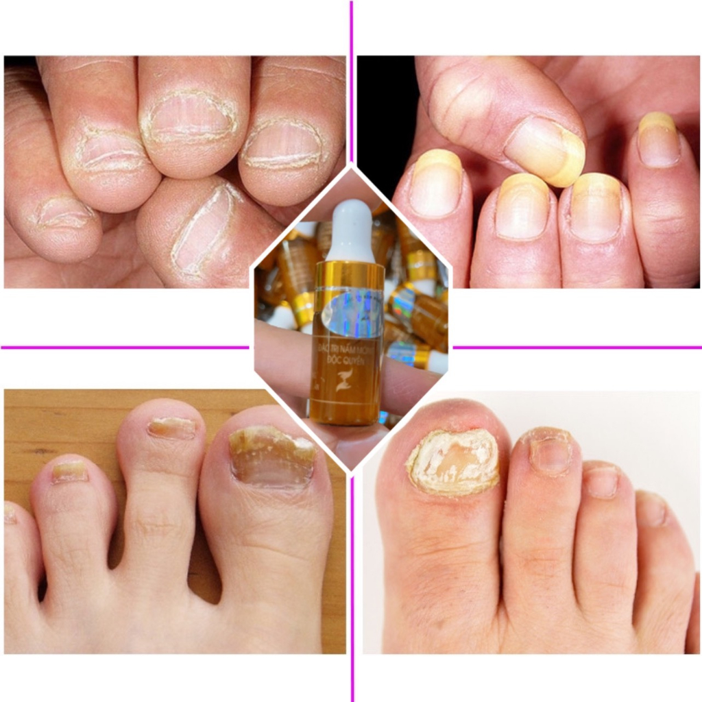 Serum Nấm Móng Tay Chân Nhỏ Khóe Móng Hết Sưng Đau, Bọng Móng Hiệu Quả Sau Vài Giọt