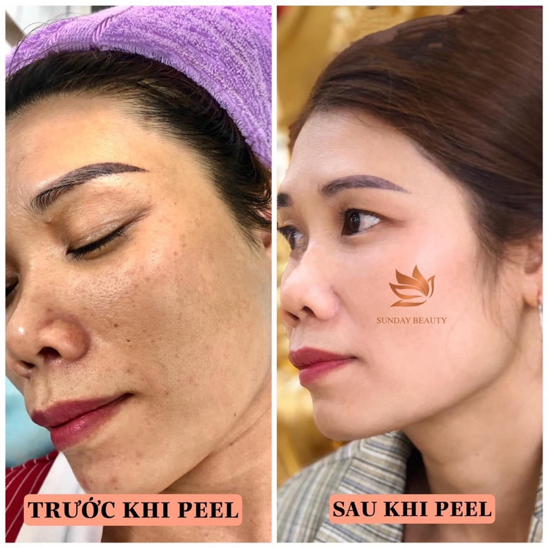 Peel da ROYCE SKIN M+ da bong mảng to bóc tách nám tàn nhang sẹo rỗ lõm mụn thâm m0