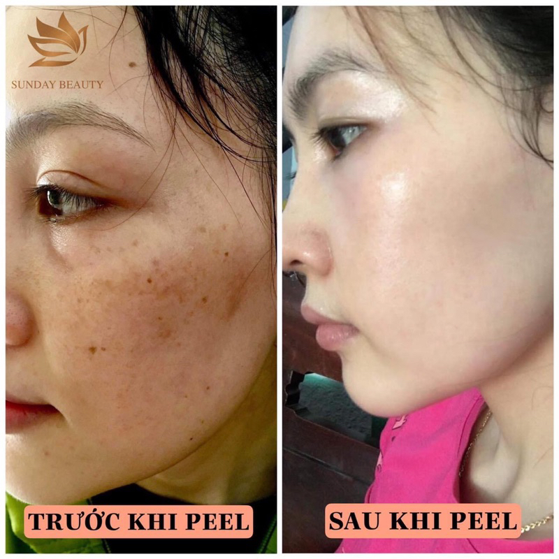 Peel da ROYCE SKIN M+ bóc tách sẹo rỗ lom mụn thâm nám tàn nhang da bong mảng to m0