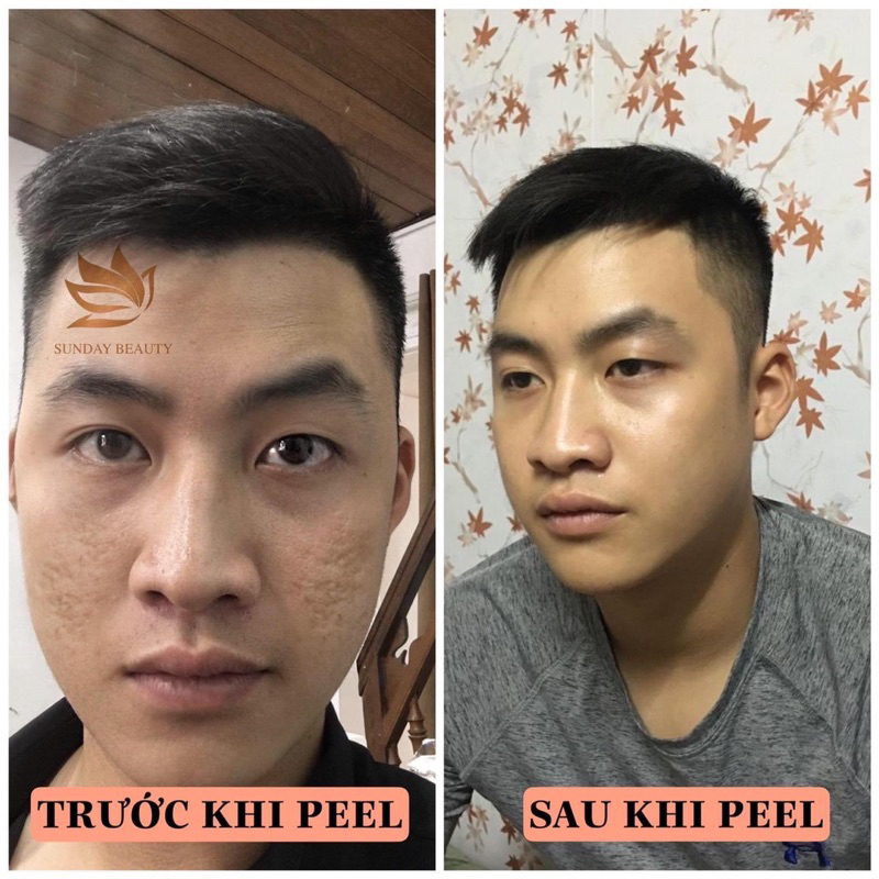 Peel da ROYCE SKIN M+ bóc tách sẹo rỗ lom mụn thâm nám tàn nhang da bong mảng to m0