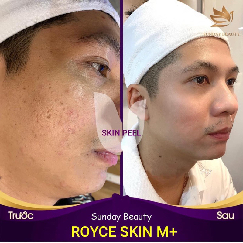 Peel da ROYCE SKIN M+ bóc tách mụn thâm sẹo rỗ lõm nám tàn nhang da bong mảng to m0