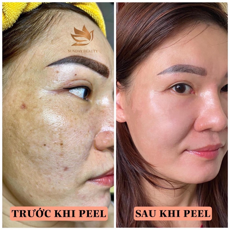 Peel da ROYCE SKIN M+ bóc tách sẹo rỗ lõm nám tàn nhang mụn thâm da bong mảng to m0