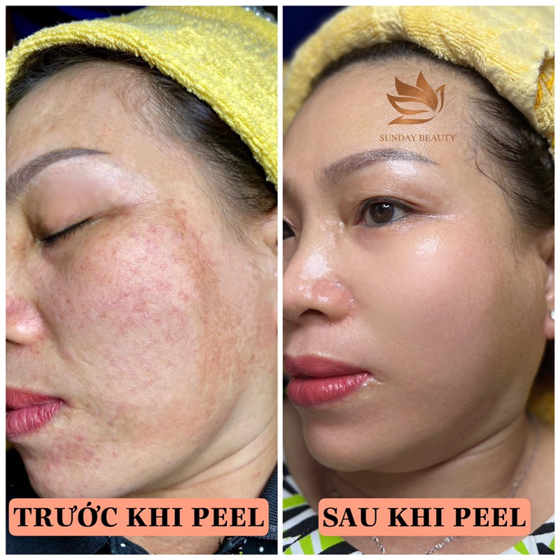 Peel da ROYCE SKIN M+ bóc tách nám tàn nhang sẹo rỗ lõm mụn thâm da bong mảng to m0