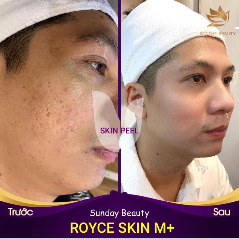 Peel da ROYCE SKIN M+ bóc tách nám tàn nhang sẹo rỗ lõm mụn thâm da bong mảng to m0