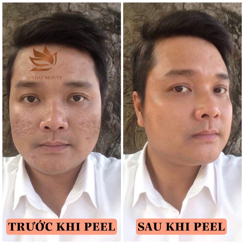 Peel da ROYCE SKIN M+ bóc tách nám tàn nhang sẹo rỗ lõm mụn thâm da bong mảng to m0