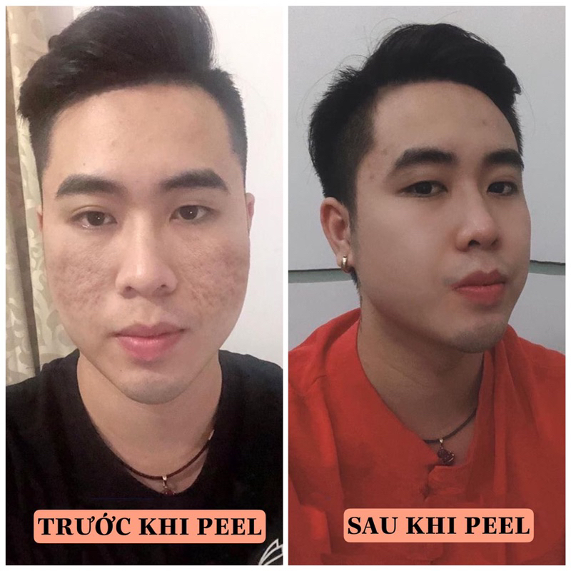 Peel da ROYCE SKIN M+ da bong mảng to bóc tách mụn thâm sẹo rỗ lom nám tàn nhang m0