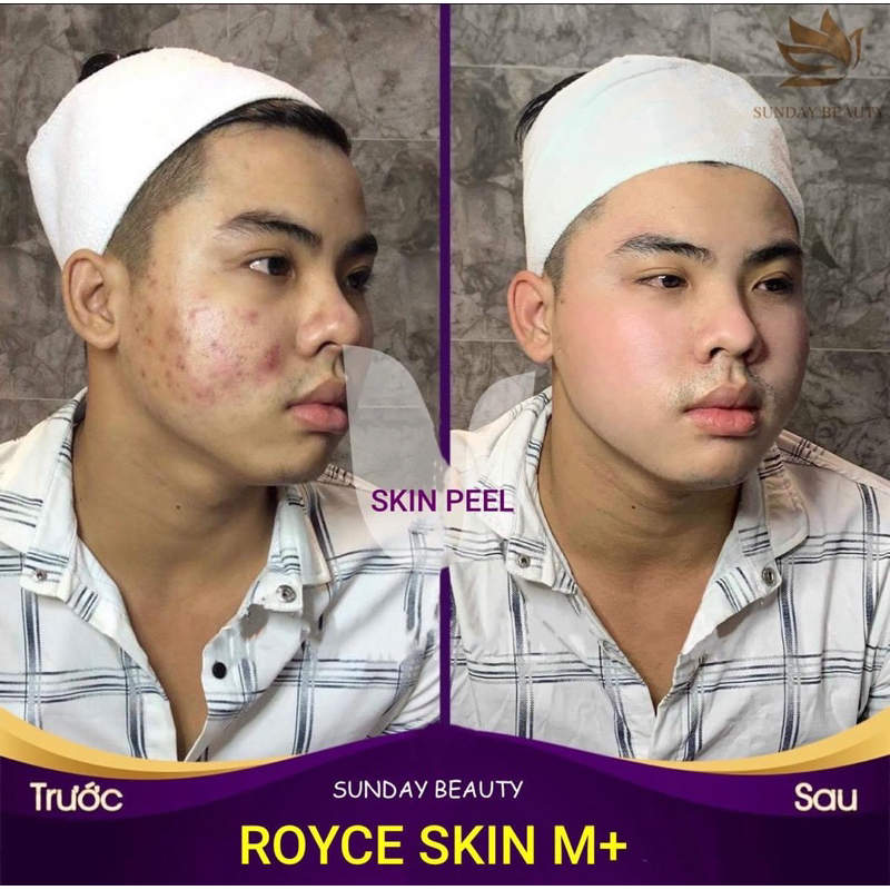 Peel da ROYCE SKIN M+ da bong mảng to bóc tách mụn thâm sẹo rỗ lom nám tàn nhang m0