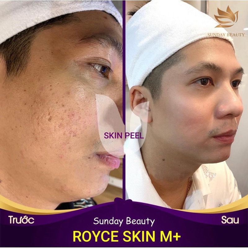 Peel da ROYCE SKIN M+ Da bong mảng to bóc tách mụn thâm nám tàn nhang sẹo rỗ lõm m0