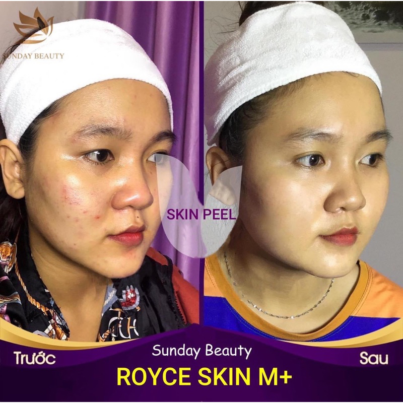 Peel da ROYCE SKIN M+ da bong mảng to bóc tách sẹo rỗ lom nám tàn nhang mụn thâm m0
