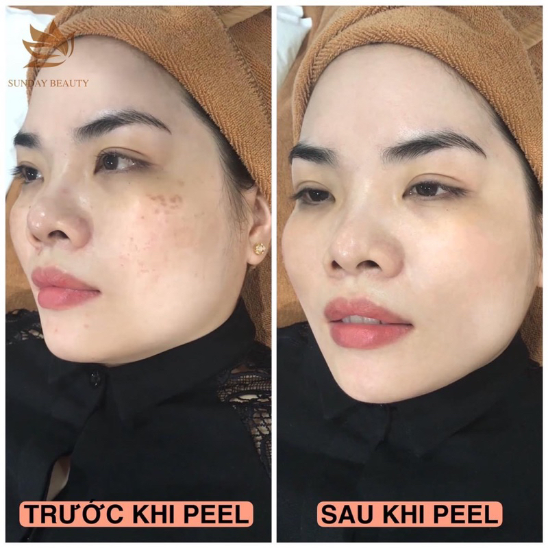 Peel da ROYCE SKIN M+ bong mảng to bóc tách nám tàn nhang sẹo rỗ lõm mụn thâm m0