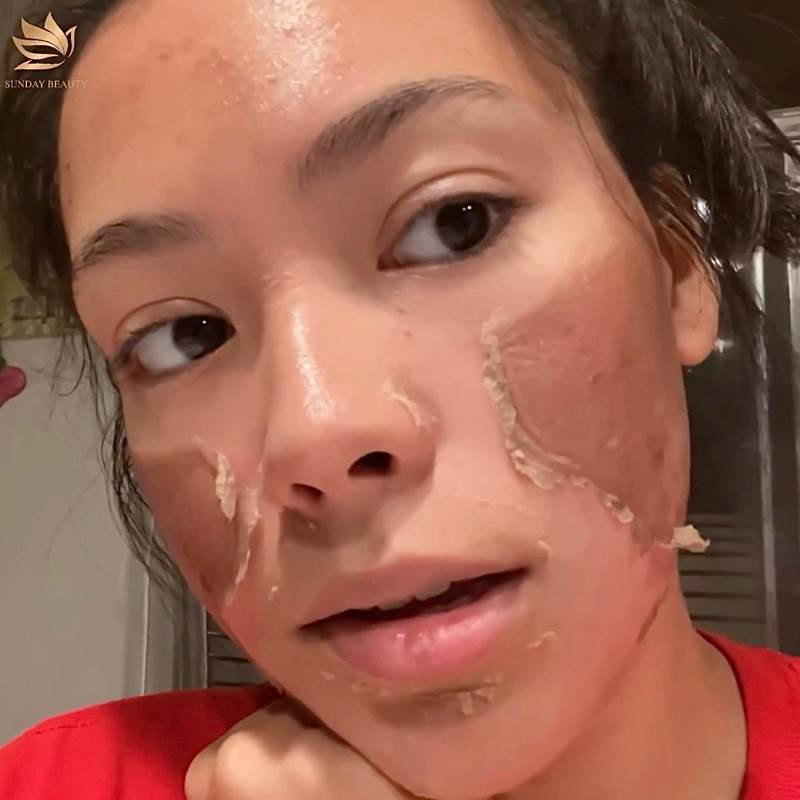 Peel da ROYCE SKIN M+ da bong mảng to bóc tách sẹo rỗ lom nám tàn nhang mụn thâm m0