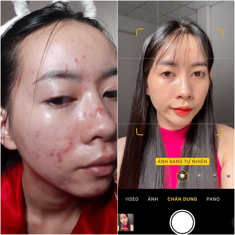 Serum mụn Beskin Herbal Serum