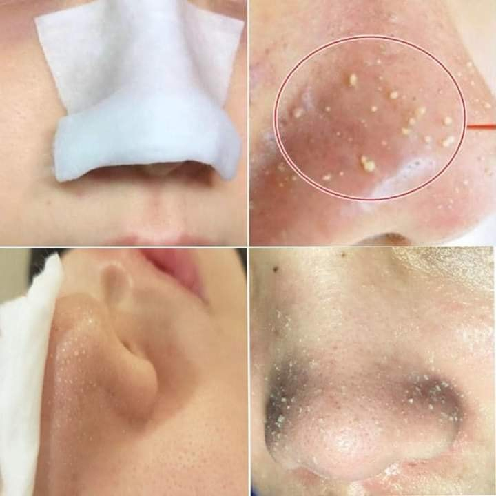 Ủ MỤN EXTRA SUPER 9+