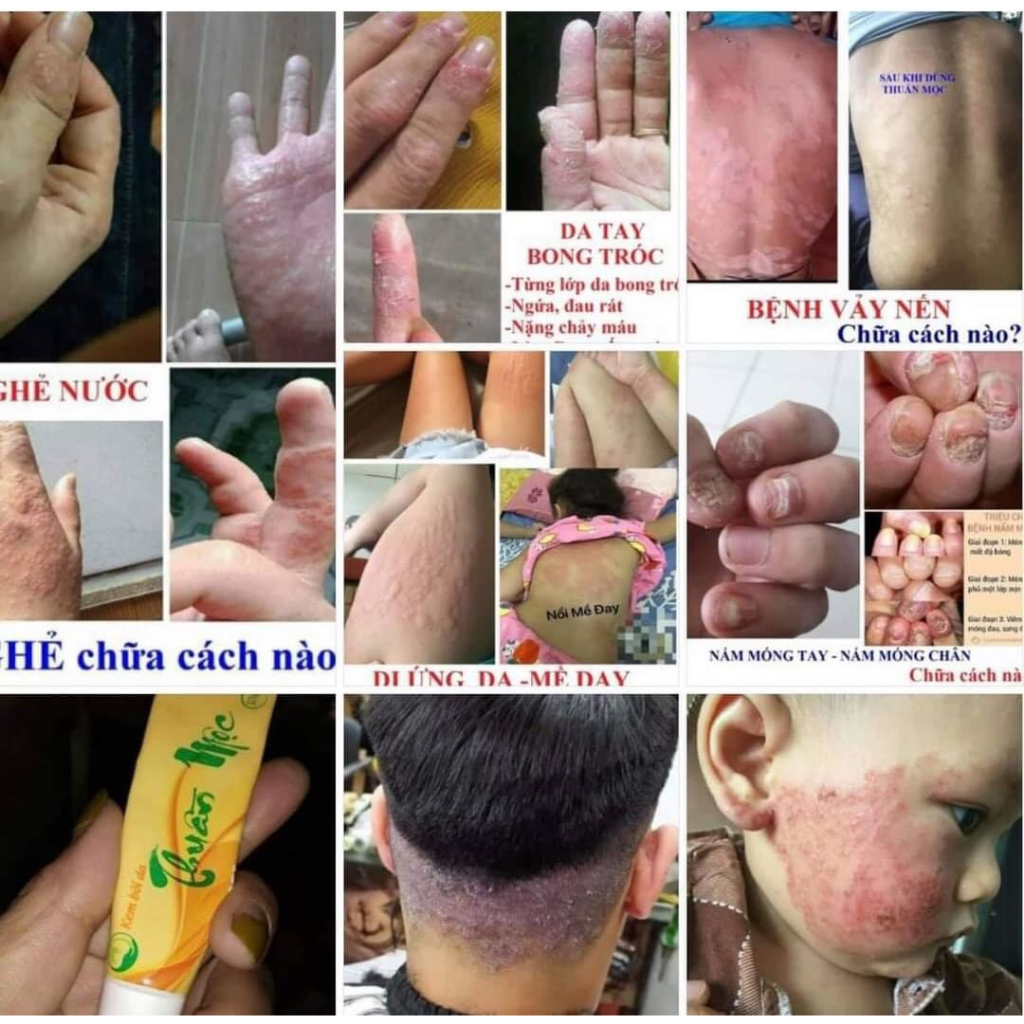 Kem bôi da Thuần Mộc, kem bôi nấm ngứa, viêm da, hắc lào, dưỡng ẩm da 16g