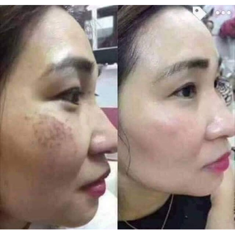 Bộ đôi kem abutin dưỡng trắng + serum sâm sạch nám ban đêm.