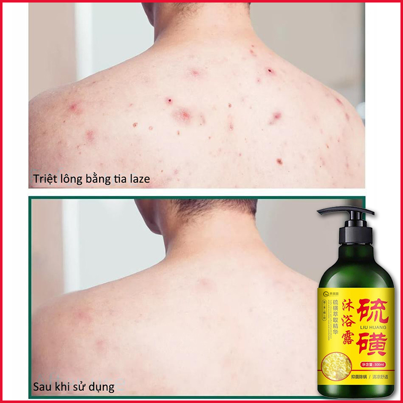 Sữa tắm trắng da Sữa tắm loại bỏ mụn Sữa tắm mụn lưng 500ml Làm sạch sâu bụi bẩn dưới da Cải thiện mụn trứn