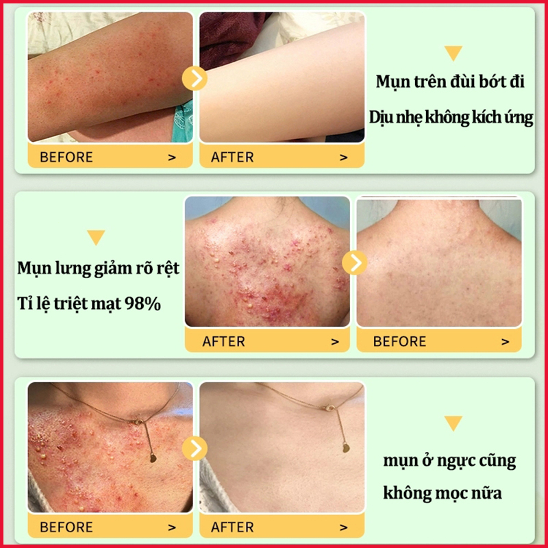 Sữa tắm trắng da Sữa tắm loại bỏ mụn Sữa tắm mụn lưng 500ml Làm sạch sâu bụi bẩn dưới da Cải thiện mụn trứn