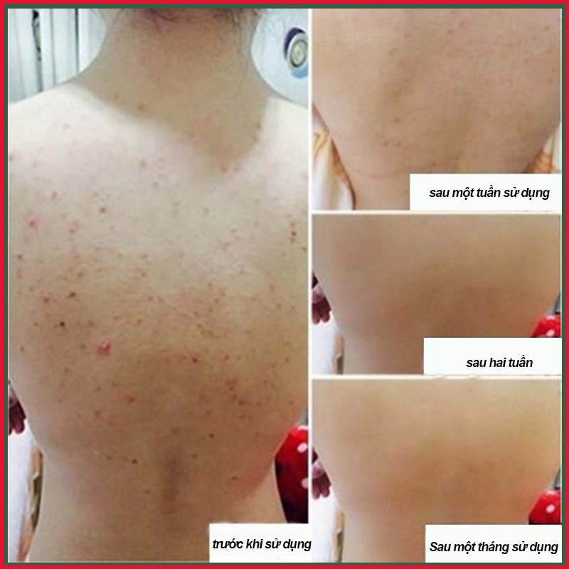 Sữa tắm trắng da Sữa tắm loại bỏ mụn Sữa tắm mụn lưng 500ml Làm sạch sâu bụi bẩn dưới da Cải thiện mụn trứn
