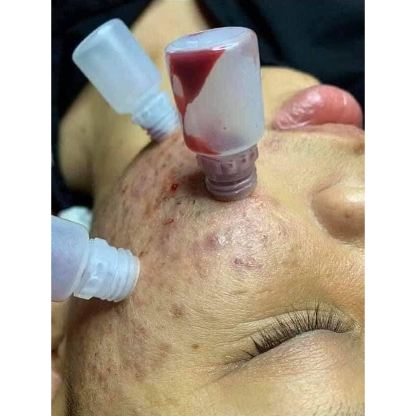 Ống hút máu bầm bịch 100 chiếc