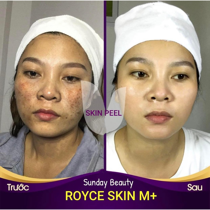 Peel da ROYCE SKIN M+ Thay da toàn diện tái tạo vẻ đẹp tiềm năng