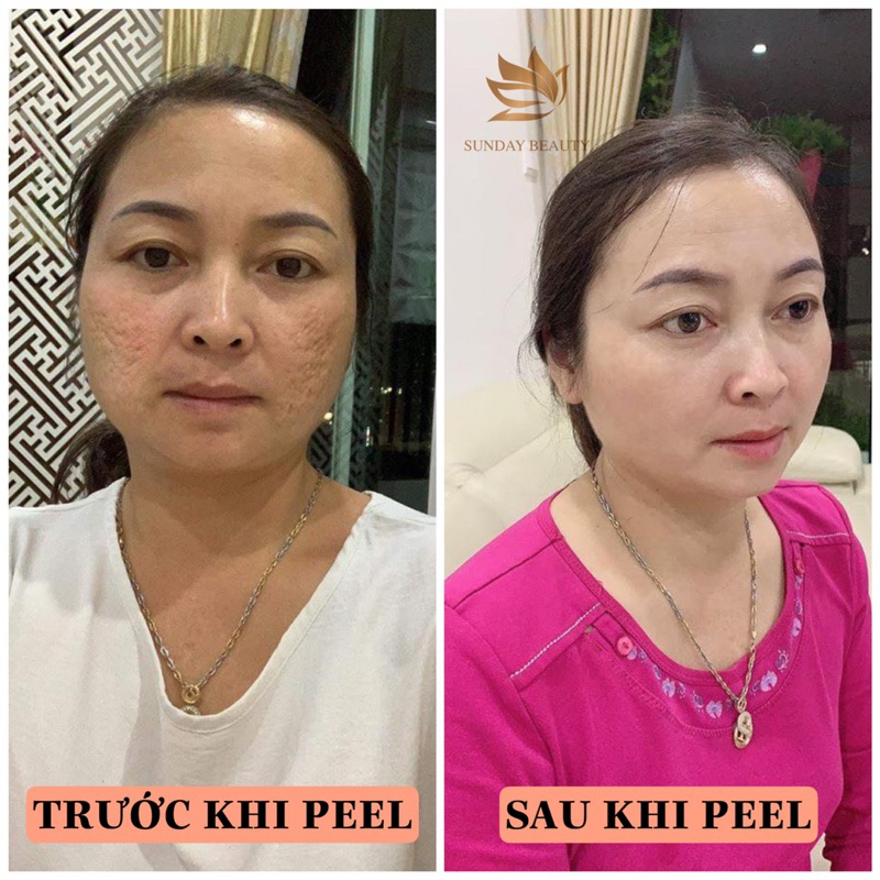 Peel da ROYCE SKIN M+ Da bong mảng to peel da làm đẹp theo xu hướng