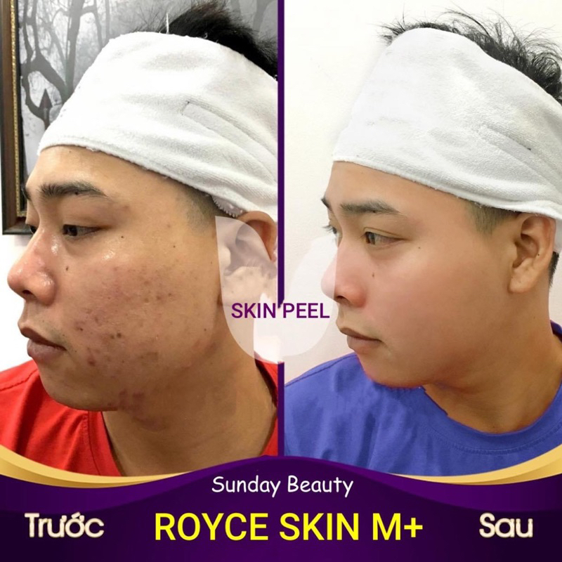 Peel da ROYCE SKIN M+ Peel da tiện lợi dễ sử dụng